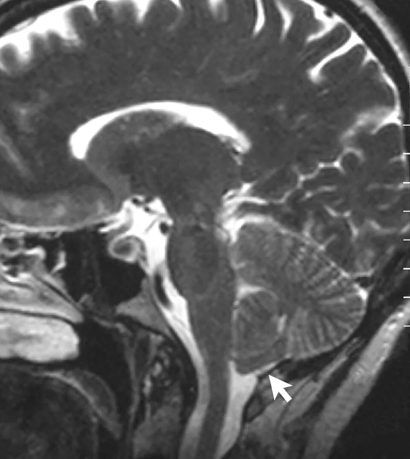 Pretty Pictures, Murky Science: How Brain Imaging Studies Became Nootropic Marketing Gold